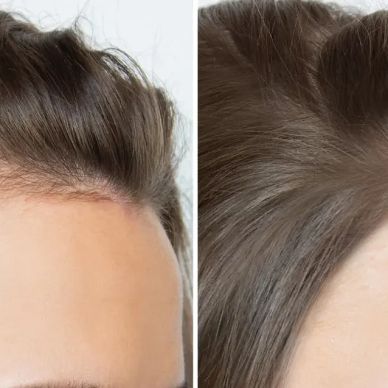 1722347062Hair_Loss_Treatment_For_Women