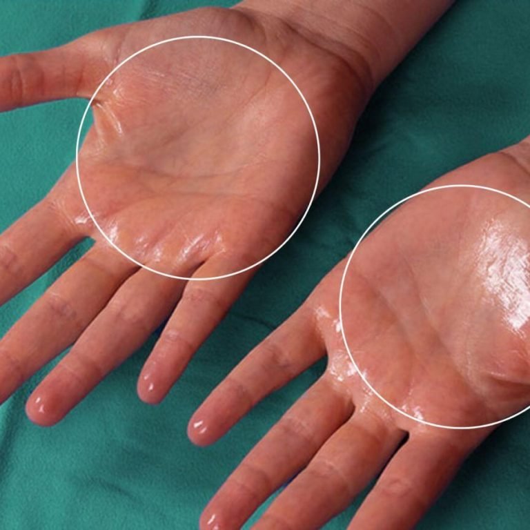 Hyperhidrosis-II-1200x900