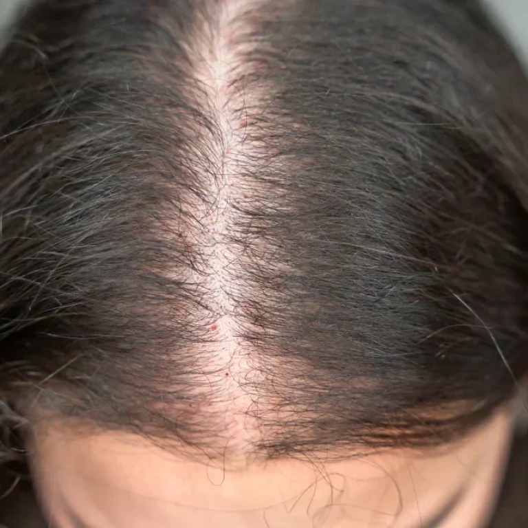 hair-thinning-causes-types-treatments_c4c354ac-0f4b-4312-89c8-36b8fc87591d